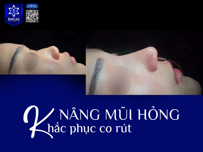 Khi mũi đã bị co rút, việc khắc phục cần được thực hiện bởi bác sĩ có chuyên môn và kinh nghiệm, vì đây là ca tái phẫu thuật phức tạp liên quan đến cả mô sẹo, cấu trúc đầu mũi và độ dày da.