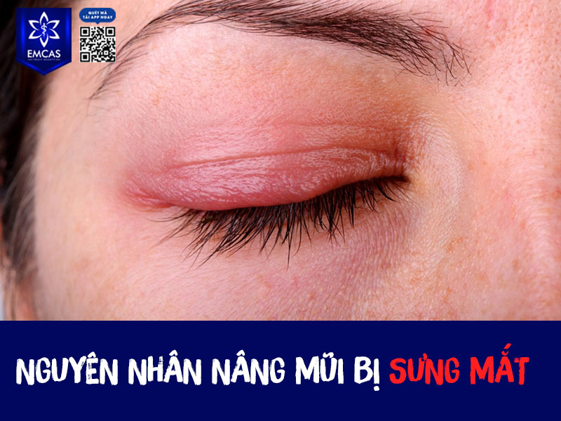 Nâng mũi bị sưng mắt có thể bắt nguồn từ nhiều nguyên nhân khác nhau, bao gồm yếu tố cơ địa, kỹ thuật phẫu thuật hoặc cách chăm sóc hậu phẫu.