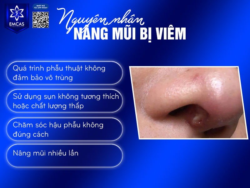 Tình trạng nâng mũi bị viêm có thể bắt nguồn từ nhiều nguyên nhân khác nhau, bao gồm cả yếu tố chủ quan lẫn khách quan.