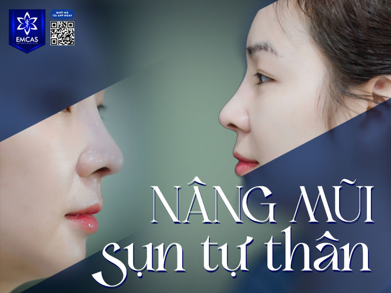 Bọc sụn là lựa chọn phù hợp cho những ai mong muốn sở hữu dáng mũi tự nhiên, thanh thoát nhưng vẫn đảm bảo độ an toàn.