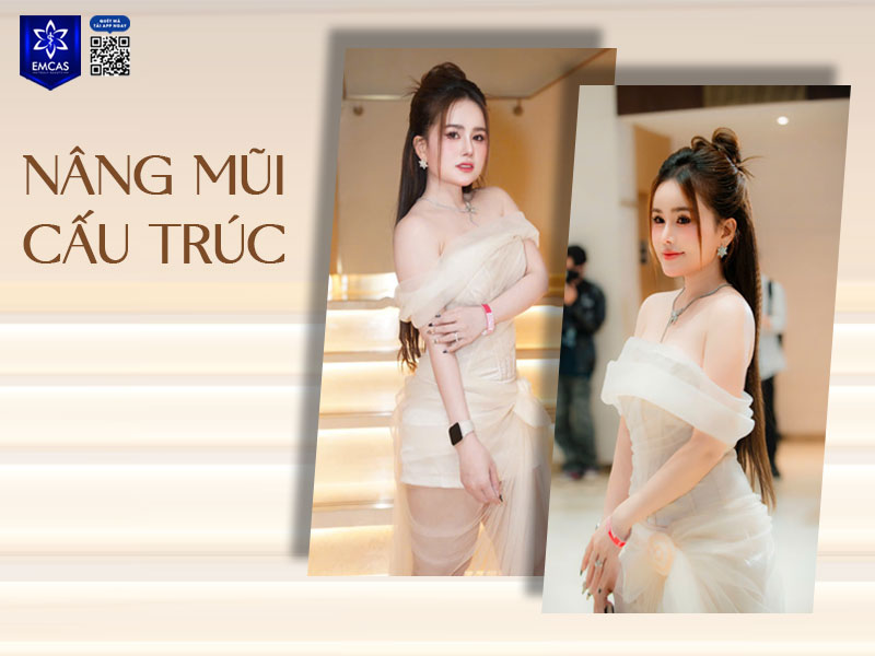 Gom mũi là quá trình mô mềm co hồi, ôm sát sụn và ổn định hình dáng