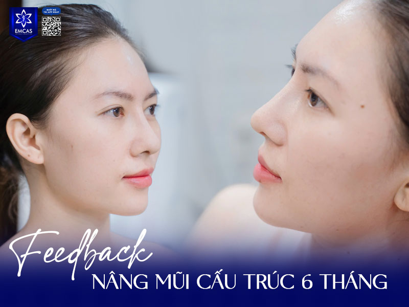 Tuần 5 trở đi, mô ổn định dần, mô xơ bắt đầu hình thành bền vững, mũi mềm, gom form rõ.