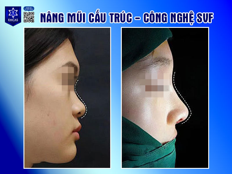Nâng mũi cấu trúc Pureform là kỹ thuật tái cấu trúc toàn bộ dáng mũi kết hợp sử dụng sụn Pureform – một loại sụn sinh học an toàn, tương thích tốt với cơ thể, hạn chế đào thải, dị ứng.