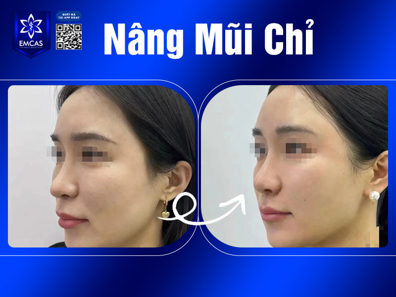 Việc lựa chọn phương pháp nâng mũi bằng chỉ còn phụ thuộc vào tình trạng mũi hiện tại, mức độ kỳ vọng về kết quả và mong muốn thẩm mỹ của bạn.