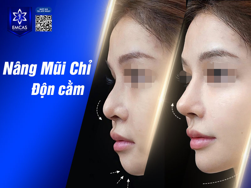 Tại TP.HCM, Bệnh Viện Thẩm Mỹ EMCAS là một trong những đơn vị nâng mũi chỉ ứng dụng công nghệ hiện đại, kết hợp cùng quy trình khép kín, an toàn.