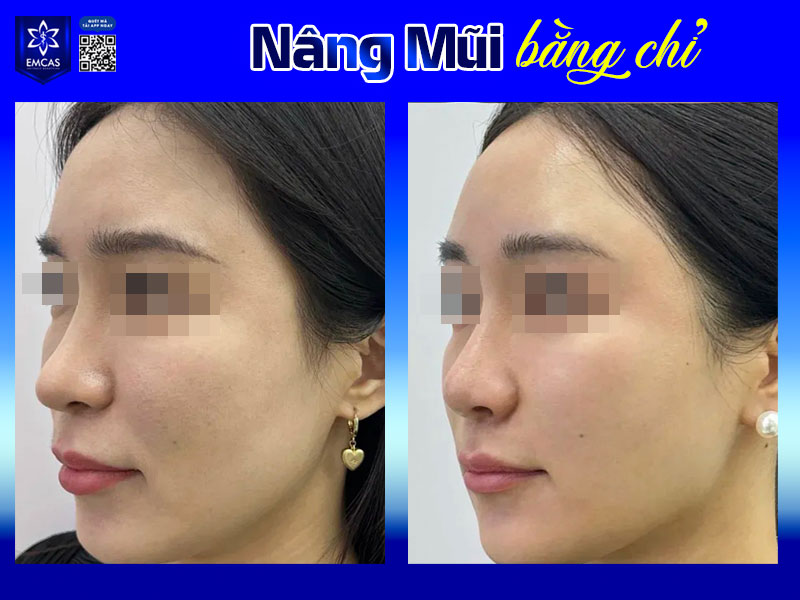 Nâng mũi bằng chỉ thông thường giữ được từ 6 tháng đến 2 năm