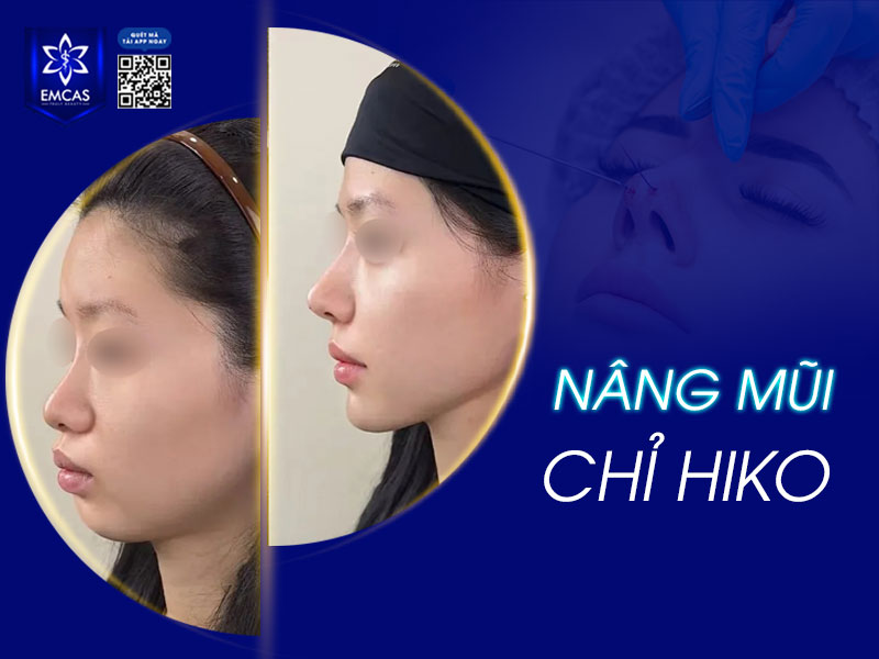 Khi được thực hiện tại cơ sở uy tín, bởi bác sĩ có chuyên môn, nâng mũi chỉ Hiko không chỉ đảm bảo an toàn mà còn mang lại dáng mũi cao thanh thoát, tự nhiên.