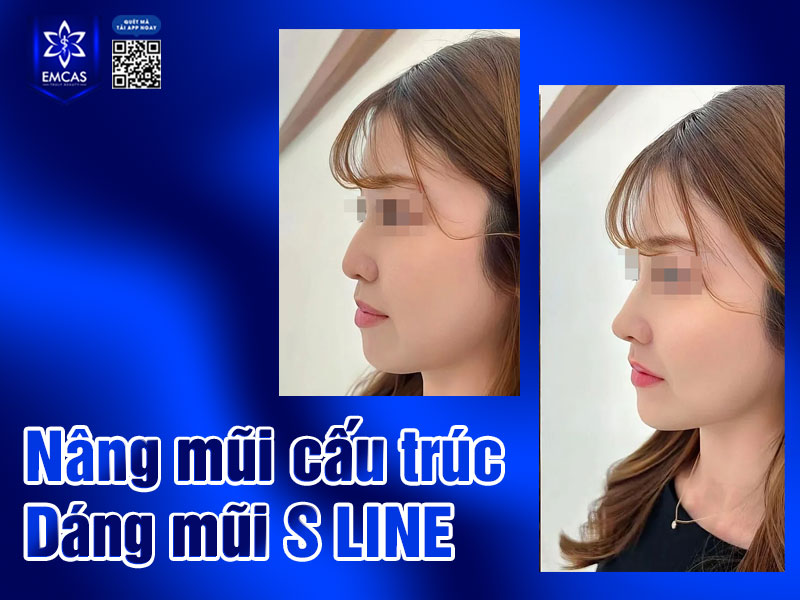 Dáng mũi S-Line mang đến sự mềm mại và hài hòa nhờ đường cong nhẹ nhàng từ sống mũi đến đầu mũi. 