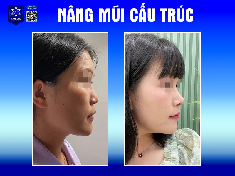 Sau khi nâng mũi từ khoảng 7-10 ngày, vết thương bắt đầu bớt sưng, bạn có thể cắt chỉ và tháo nẹp