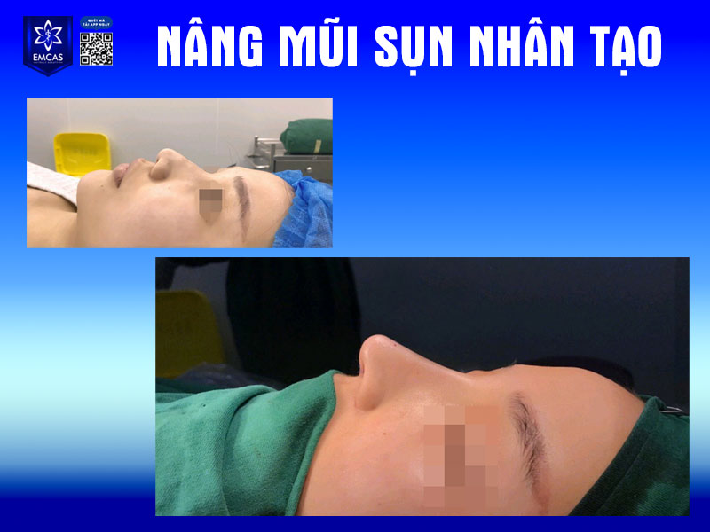 Quá trình phẫu thuật nâng mũi được thực hiện trong trạng thái gây mê, bạn sẽ không cảm thấy đau hay khó chịu gì