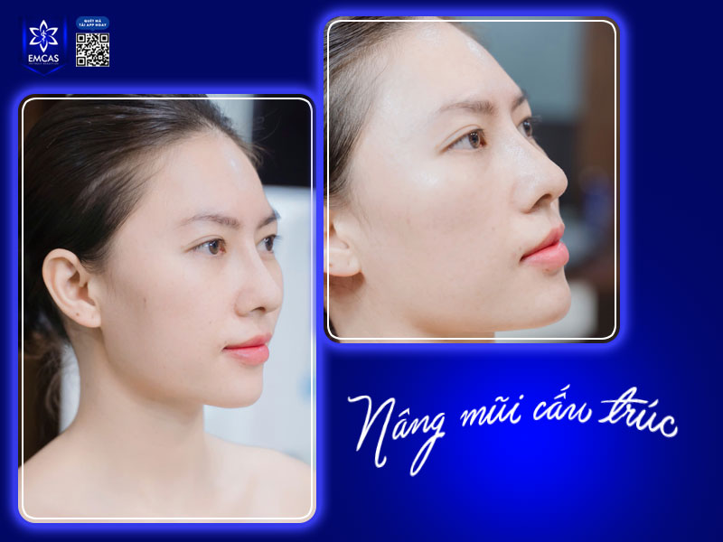 chi phí nâng mũi cấu trúc có giá dao động từ 35 triệu đồng