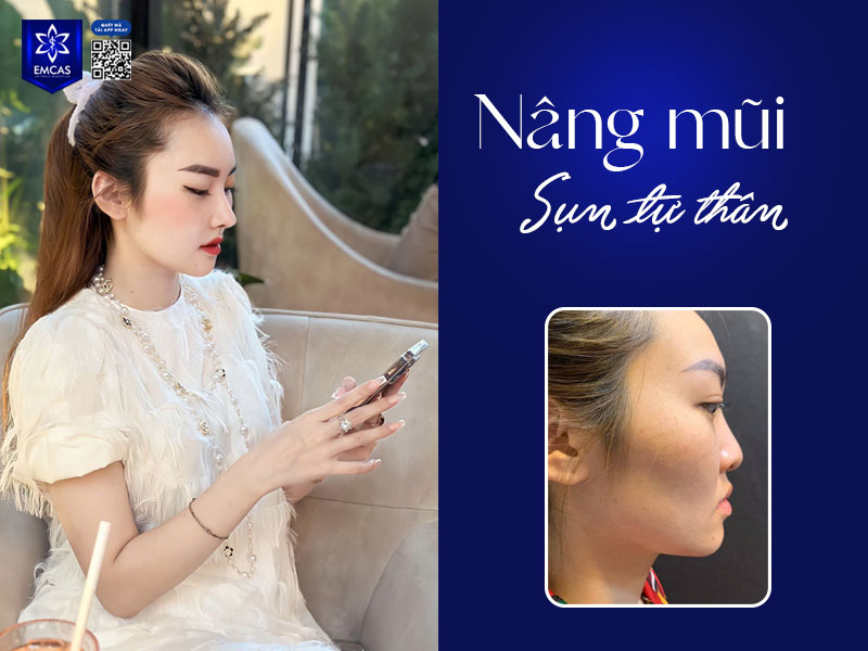 giá nâng mũi sụn tự thân dao động từ 25 triệu đồng trở lên