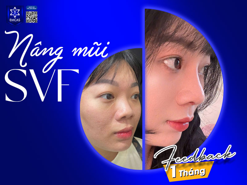 giá sửa mũi của phương pháp SVF cũng có sự khác biệt so với các dịch vụ nâng mũi khác, dao động từ 17 triệu đồng trở lên