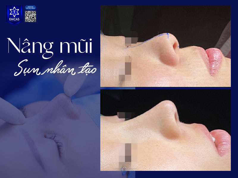 Giá nâng mũi không chỉ là một con số cố định mà còn phụ thuộc vào nhiều yếu tố khác như tay nghề bác sĩ, cơ sỡ uy tín, phương pháp, máy móc