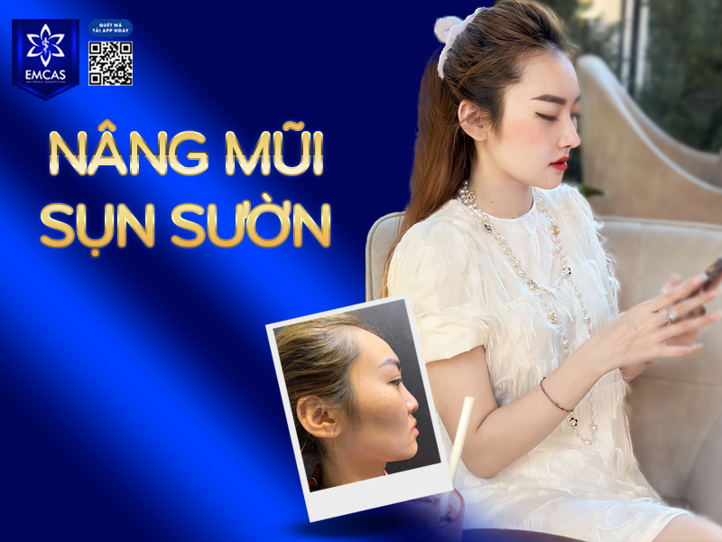 Đặt sống nâng mũi Hàn Quốc là phương pháp thẩm mỹ sử dụng sụn nhân tạo hoặc sụn sườn để nâng cao phần sống mũi, giúp dáng mũi trở nên cao, thẳng.