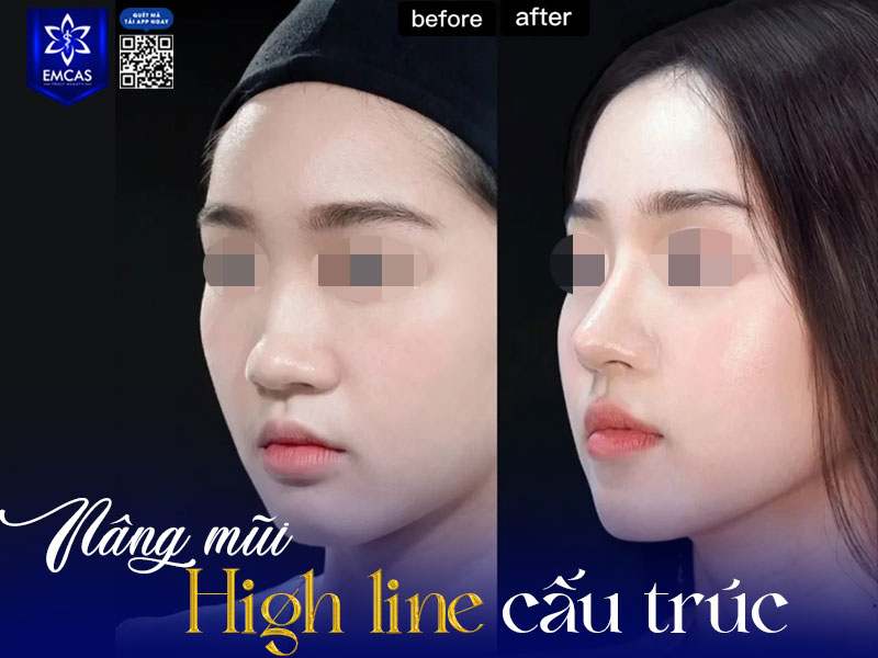Nâng mũi High Line cấu trúc là phương pháp thẩm mỹ tiên tiến giúp chỉnh sửa toàn diện cấu trúc mũi, từ sống, đầu mũi đến trụ mũi, mang lại dáng mũi cao, thẳng. Hình 5: text: nâng mũi high line sụn sườn