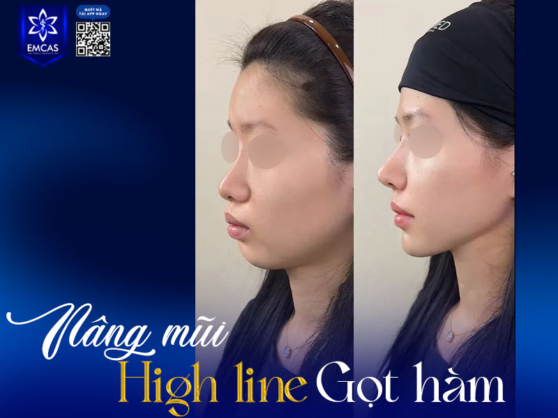 Thời gian duy trì kết quả sau khi dáng mũi High Line phụ thuộc vào nhiều yếu tố như phương pháp thực hiện, loại sụn sử dụng, tay nghề bác sĩ và cách chăm sóc hậu phẫu.