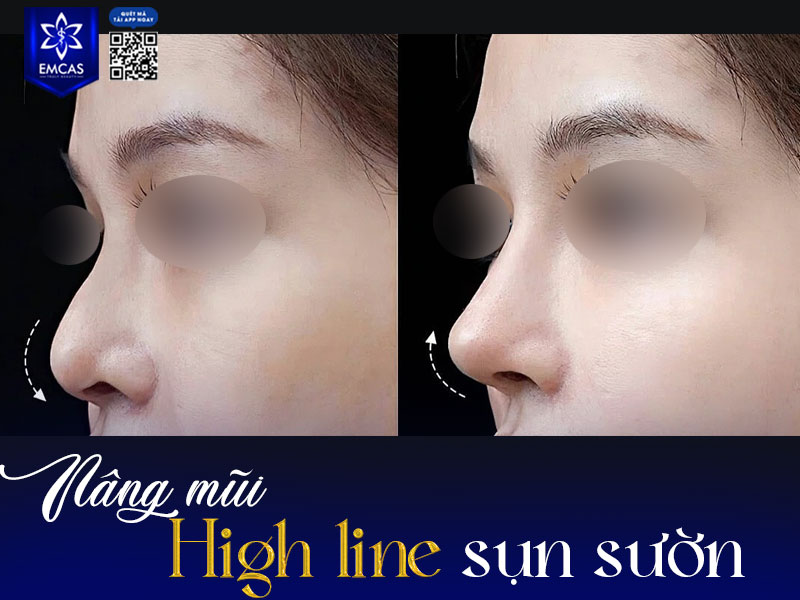 Dáng mũi High Line sụn sườn sử dụng sụn tự thân lấy từ xương sườn để dựng trụ mũi, kéo dài đầu mũi và nâng sống, mang lại dáng mũi cao, thẳng và tự nhiên