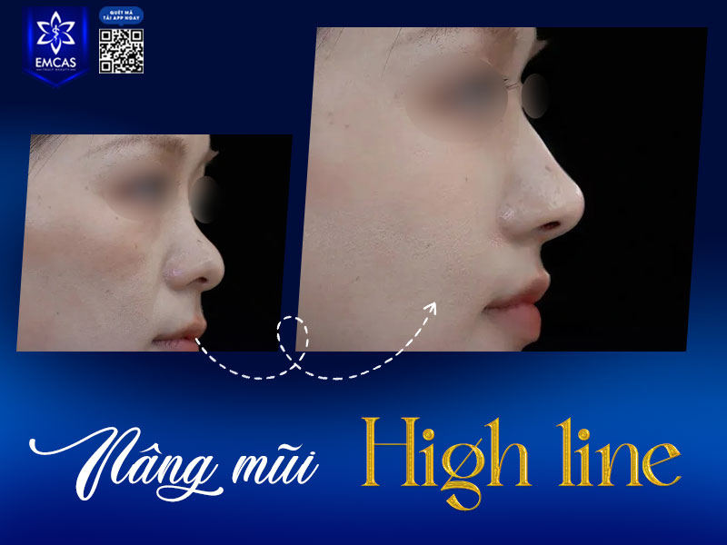 Để đảm bảo an toàn và mang lại dáng mũi cao, thẳng, sắc nét, Bệnh Viện Thẩm Mỹ EMCAS thực hiện quy trình phẫu thuật mũi High Line theo y khoa với 6 bước.