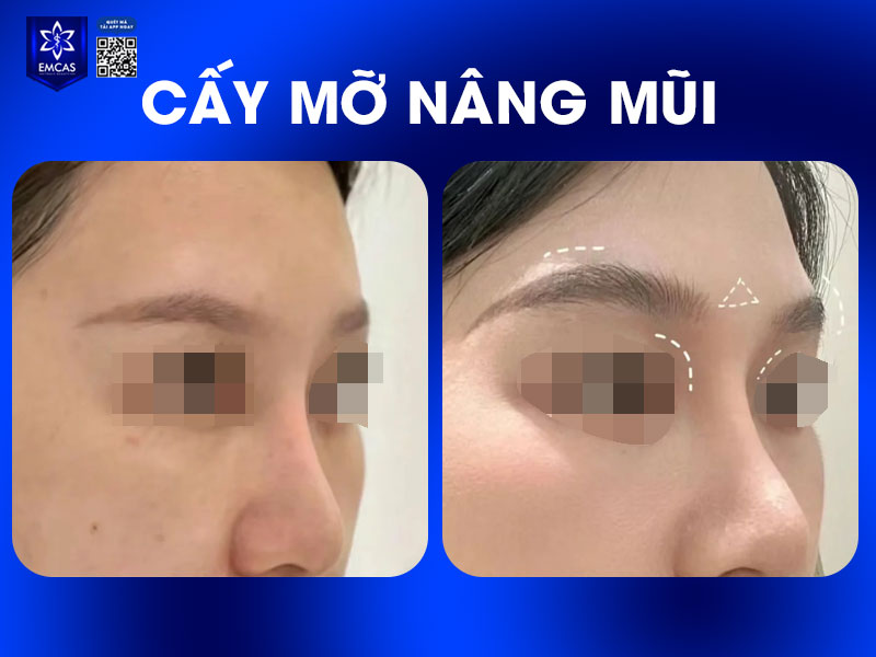 Cấy mỡ nâng mũi sử dụng mỡ tự thân tiêm vào phần mũi để làm đầy vùng khuyết lõm