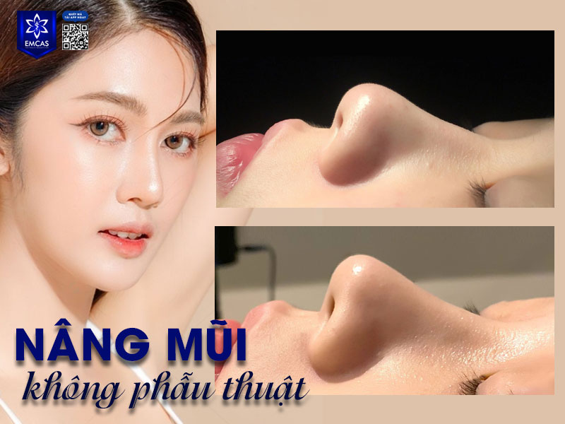 Bệnh Viện Thẩm Mỹ EMCAS là địa chỉ nâng mũi không phẫu thuật uy tín với đội ngũ y bác sĩ chuyên môn sâu, giàu kinh nghiệm