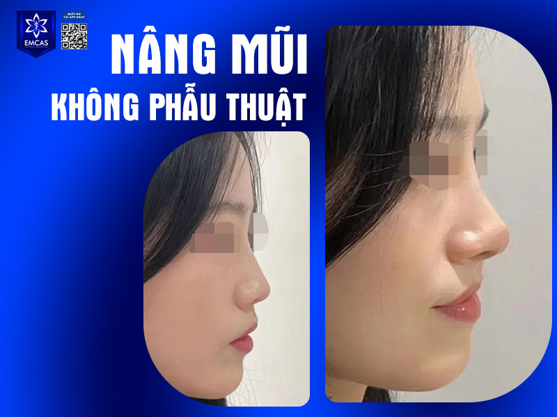 Nâng mũi không phẫu thuật là phương pháp làm đẹp phổ biến với nhiều ưu điểm nổi bật