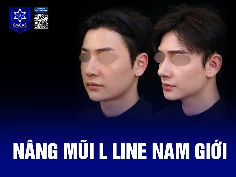 Quy trình nâng mũi L line cho nam tại Bệnh Viện Thẩm Mỹ EMCAS được thực hiện theo 6 bước, đảm bảo an toàn, mang lại dáng mũi nam tính, hài hòa và tự nhiên.