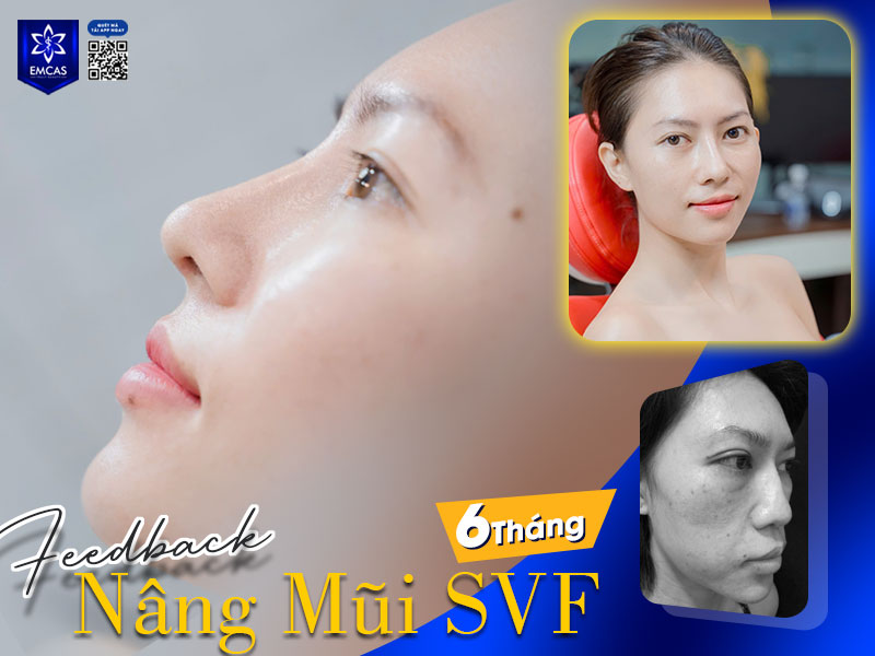 Thông thường, mũi sẽ gom form và vào dáng tự nhiên nhất sau khoảng 3–6 tháng