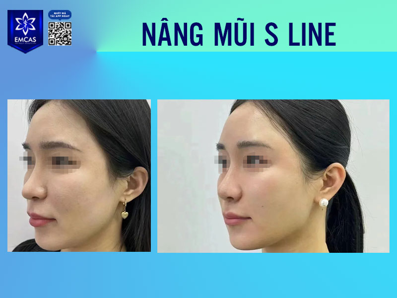 Giá tiền nâng mũi S Line không cố định mà dao động tùy theo kỹ thuật áp dụng, chất liệu sụn, tay nghề bác sĩ và uy tín cơ sở thực hiện