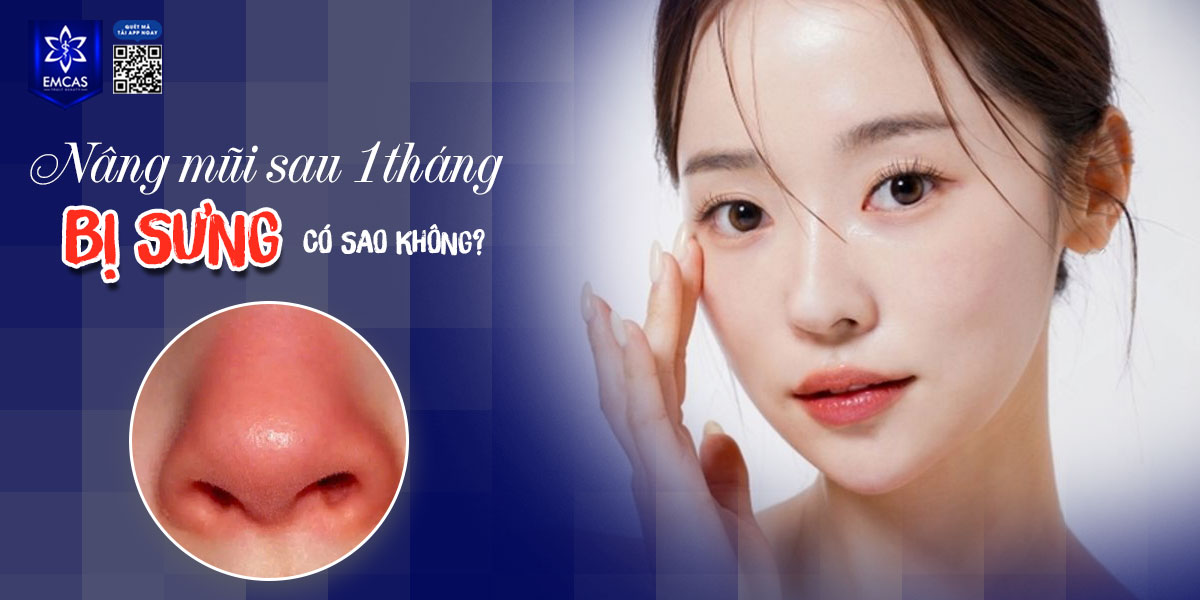 NÂNG MŨI SAU 1 THÁNG BỊ SƯNG CÓ SAO KHÔNG?