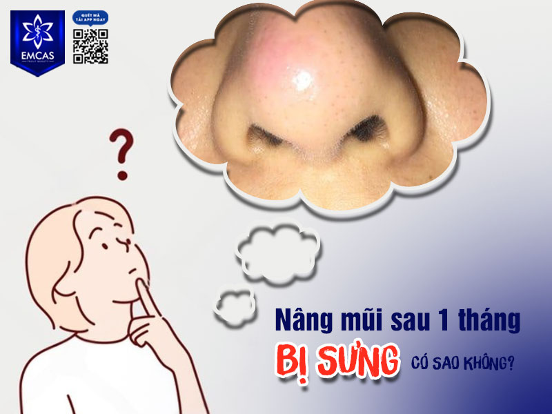 Nếu nâng mũi sau 1 tháng bị sưng, kèm theo cảm giác đau, đỏ, nóng hoặc có dấu hiệu bất thường, bạn cần đặc biệt lưu ý.
