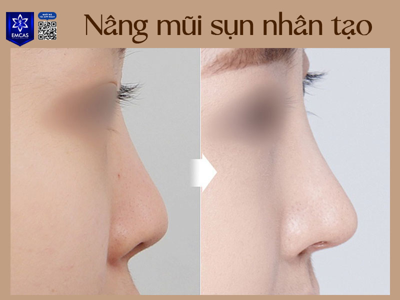 Mỗi loại đều có những ưu và nhược điểm riêng, giúp mang lại kết quả thẩm mỹ như mong đợi, bền vững và an toàn