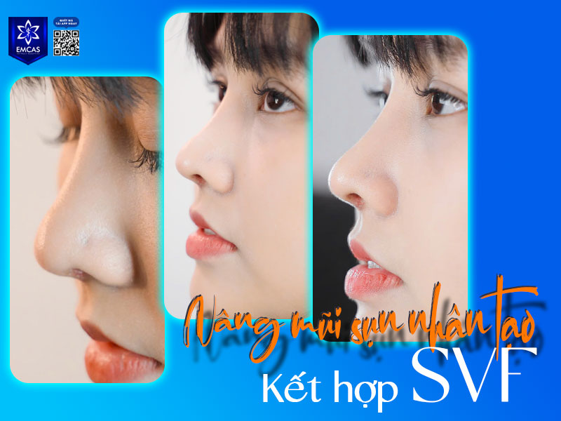 Nâng mũi sụn nhân tạo sử dụng vật liệu nhân tạo để nâng cao sống mũi, cải thiện dáng mũi thon gọn và hài hòa với khuôn mặt.