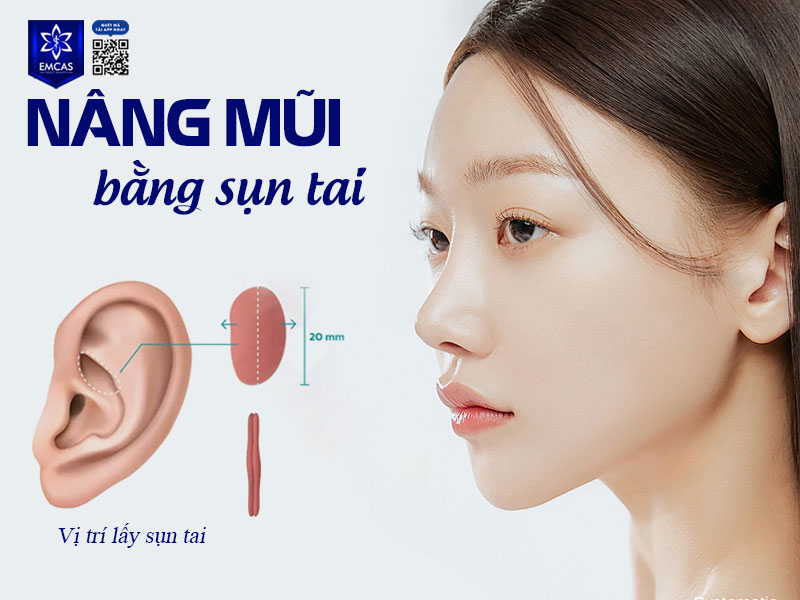 Nâng mũi sụn tai sử dụng sụn tai để bọc đầu mũi nhằm tạo độ tròn, nhô chuẩn, không lo tình trạng bóng đỏ, lộ sống hay mỏng da