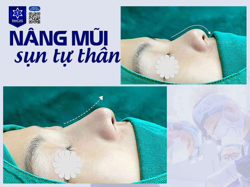 Có nhiều yếu tố ảnh hưởng đến mức giá nâng mũi dẫn đến chi phí ở mỗi cơ sở y tế lại có sự chênh lệch