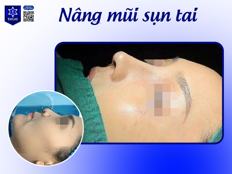 Nâng mũi sụn tai là lựa chọn lý tưởng cho những người ai muốn cải thiện dáng mũi tự nhiên, hài hòa, lâu dài