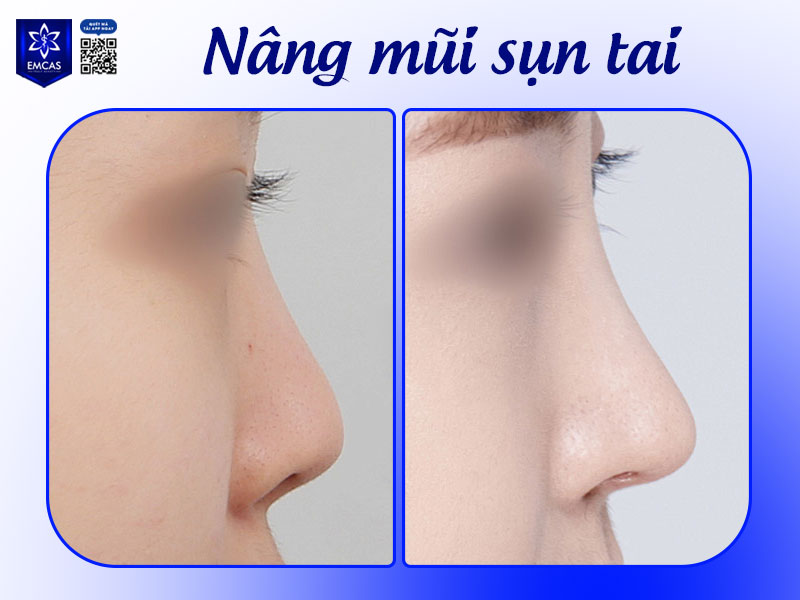 Khi kết hợp sụn tai và sụn sườn để nâng mũi, tuổi thọ có thể lên đến trọn đời