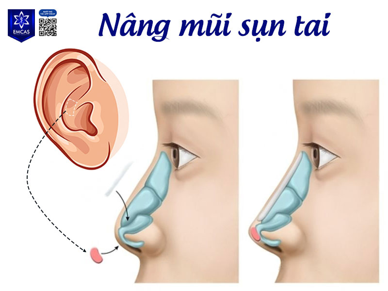 Sụn tai được lấy từ vùng vành tai khoảng 2-3 cm, dùng để bọc đầu mũi