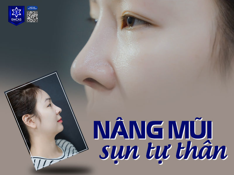 Nâng mũi sụn tự thân sử dụng vật liệu từ chính cơ thể để nâng cao, cải thiện dáng mũi