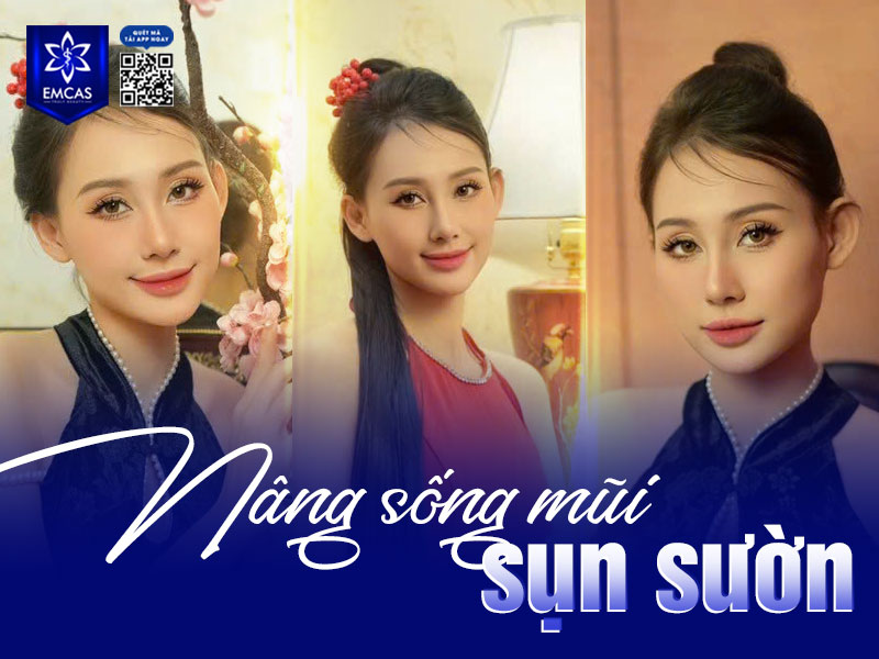 Nâng sống mũi có nhiều kỹ thuật khác nhau, tùy vào tình trạng mũi và nhu cầu thẩm mỹ của từng khách hàng.