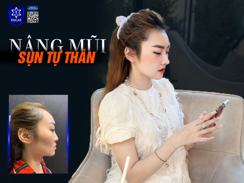 Nâng mũi bọc sụn là phương pháp nâng cao sống mũi và bọc đầu mũi bằng sụn tự thân (sụn sườn, sụn tai)