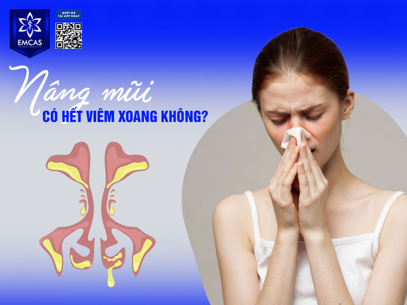nâng mũi KHÔNG có tác dụng điều trị viêm xoang. Nâng mũi là một thủ thuật thẩm mỹ nhằm cải thiện hình dạng, chiều cao, độ cân đối của mũi bên ngoài, không tác động đến các xoang trong hộp sọ, do đó không thể giúp hết viêm xoang.