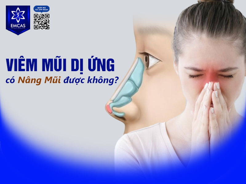 Người bị viêm mũi dị ứng vẫn có thể nâng mũi, nhưng cần được kiểm soát tốt trước phẫu thuật.
