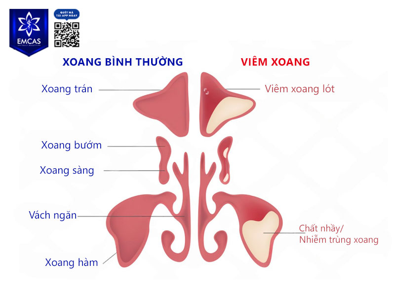 Viêm xoang là tình trạng các xoang cạnh mũi bị viêm nhiễm, sưng do virus, vi khuẩn, nấm hoặc phản ứng dị ứng kéo dài.
