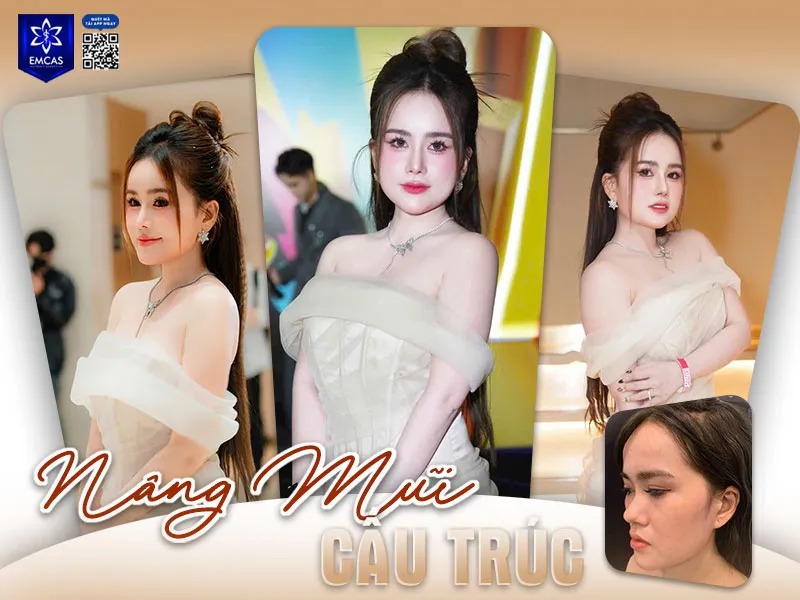 Ai nên và không nên thực hiện phẫu thuật nâng mũi