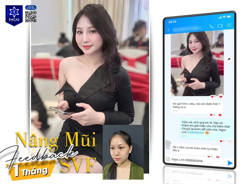Feedback khách hàng nâng mũi sau 1 tháng tại EMCAS