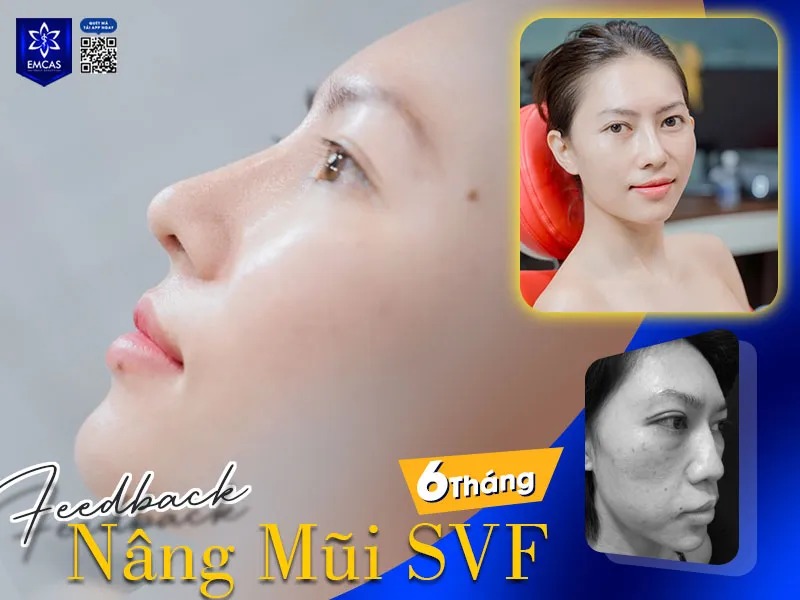Khách hàng Diễm Hương - Feedback hình ảnh nâng mũi sau 6 tháng