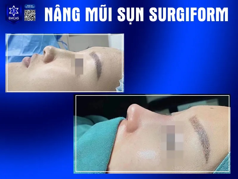 Bạn có thể cân nhắc thực hiện phẫu thuật nếu cảm thấy dáng mũi hiện tại của bản thân không hài hòa với khuôn mặt