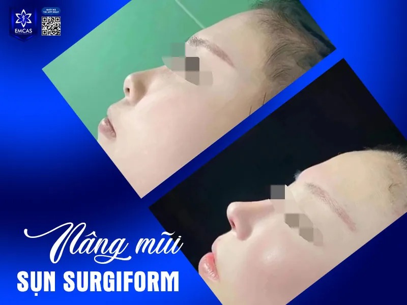 Nâng mũi sụn nhân tạo sử dụng vật liệu y tế an toàn như sụn Silicone, Surgiform, Megaderm,…