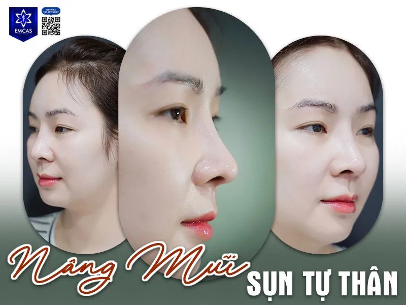 Phẫu thuật nâng mũi là một dịch vụ thẩm mỹ phổ biến hiện nay không chỉ ở Việt Nam mà trên toàn thế giới